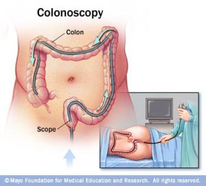 colonoscopy